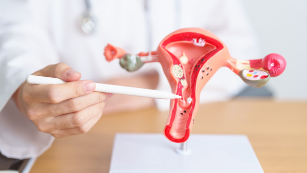 EMBOLIZAÇÃO DE MIOMAS UTERINOS EMBOLIZAÇÃO DE MIOMAS UTERINOS