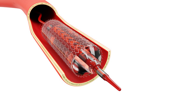 RECANALIZAÇÃO DE PORTA ASSOCIADA AO TIPS (TRANSJUGULAR INTRAHEPATIC PORTOSYSTEMIC SHUNT) RECANALIZAÇÃO DE PORTA ASSOCIADA AO TIPS (TRANSJUGULAR INTRAHEPATIC PORTOSYSTEMIC SHUNT)